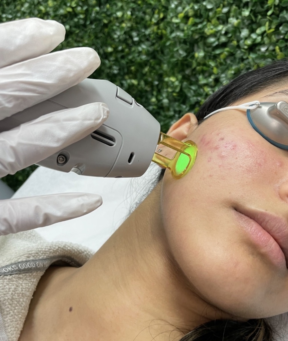 Laser hair removal service
